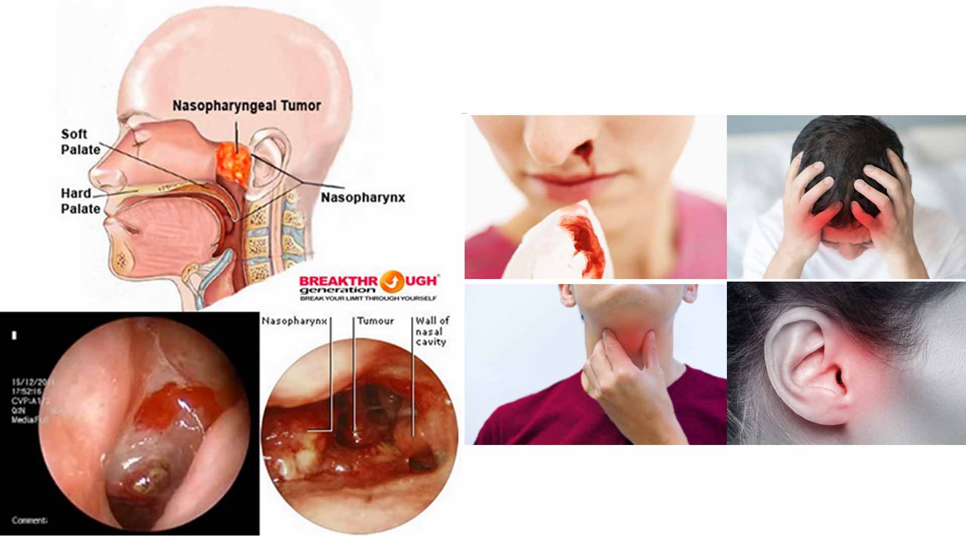 Karsinoma Nasofaring